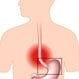 GERD (Acid Reflux) in Infants and Children
