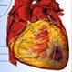 Heart Disease