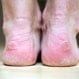 What Causes Blisters on Your Feet?