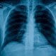 Hypersensitivity Pneumonitis