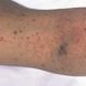 Idiopathic Thrombocytopenic Purpura (ITP)