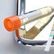 Diabetic Ketoacidosis (Causes, Symptoms, Treatment, Complications)