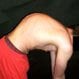 Kyphosis (Roundback)
