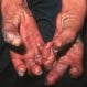 Leprosy