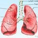 Lung Cancer