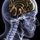 Encephalitis