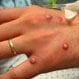 Monkeypox