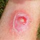 Is MRSA Contagious?