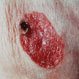 Paget Disease of the Breast (Paget's Disease of the Nipple)