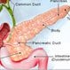 Acute and Chronic Pancreatitis