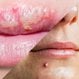 Pimple vs. Cold Sore
