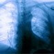 Is Pleurisy Contagious?