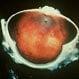 Retinitis Pigmentosa
