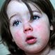 Is Scarlet Fever Contagious?