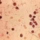 Shigella Infection