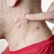 Is Shingles Contagious?