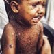 Smallpox