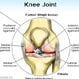 Torn ACL (Anterior Cruciate Ligament Tear)