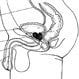 Urinary Incontinence