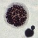 What Is Valley Fever (Coccidioidomycosis)?