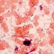 Vancomycin-Resistant Enterococci (VRE)