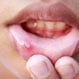 What Are Causes of Blisters in the Mouth?