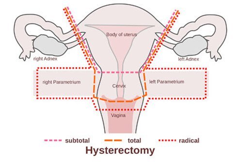 A hysterectomy may affect sexual function in women.