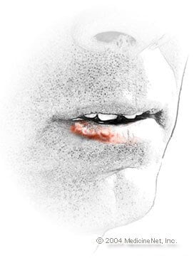 Pictures of cold sores on the lips (fever blisters, HSV-1, or herpes simplex infection type 1) Pictures of cold sores on the lips (fever blisters, HSV-1, or herpes simplex infection type 1)