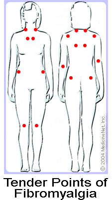 Illustration of the tender points of fibromyalgia