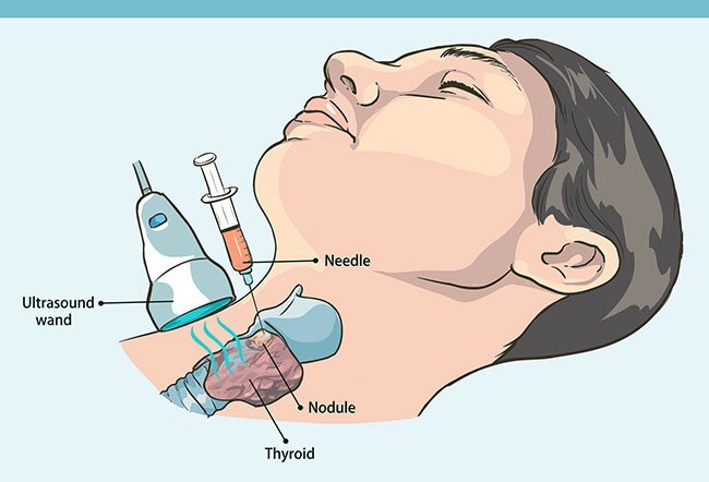 A needle biopsy is a minimally invasive procedure and does not require a large incision. 