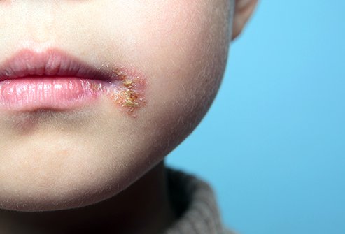Herpes Simplex Virus (HSV) is a highly contagious virus that commonly causes sores on the mouth or genitals. Once you have it, it stays in your body forever. No medication can cure it completely, though you can control it through medications and home care. Herpes Simplex Virus (HSV) is a highly contagious virus that commonly causes sores on the mouth or genitals. Once you have it, it stays in your body forever. No medication can cure it completely, though you can control it through medications and home care.
