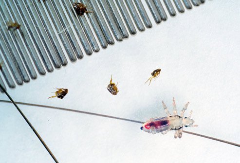 Head lice infestation can affect anyone