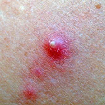 A close-up of a skin boil.