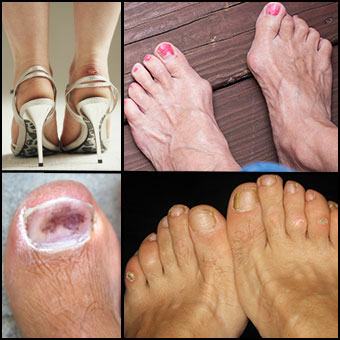 Bruises, bunions, corns, and blisters are common causes of foot pain as shown here.