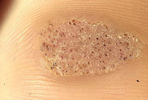 Plantar warts are viral infections that cause callused growths on the soles of the feet.
