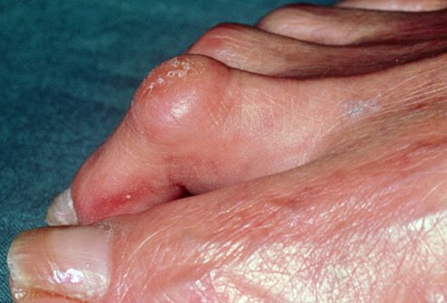 When muscles controlling the toes get out of balance, they can cause painful toe contractures.