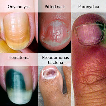 Examples of conditions that are often mistaken for fungal nails include yellow nails (onycholysis), hematoma, green nails (caused by Pseudomonas bacteria), pitted nails (usually associated with psoriasis), nail infection (paronychia), and previous injury (trauma).