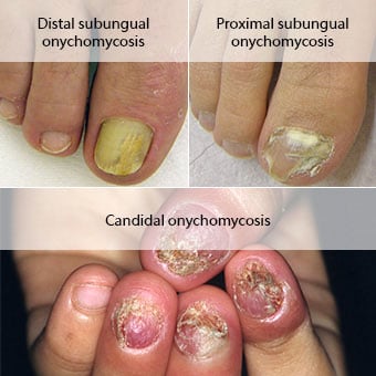 Examples of distal subungual onychomycosis, proximal subungual onychomycosis, and candidal onychomycosis.