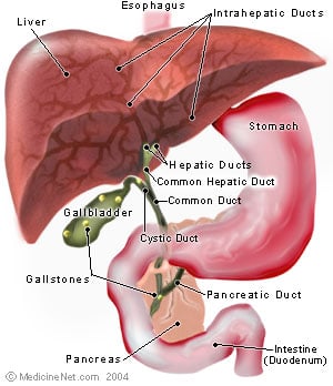 Illustration of Gallstones forming in the Gallbladder
