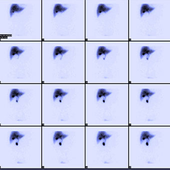 Normal hepatobiliary scan (HIDA scan) showing a series of scans done over time to see where bile is excreted and/or accumulated.