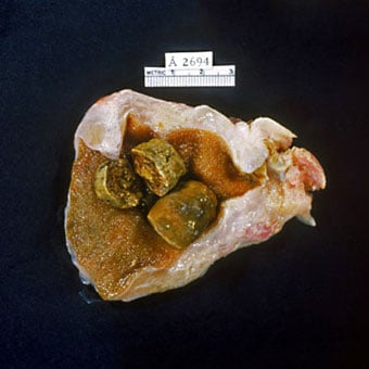 Gallbladder opened to show numerous pigmented gallstones.