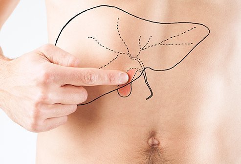 The treatment of gallstones usually involves surgical removal of the gallbladder