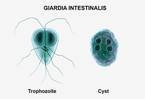Giardiasis is a parasitic infection of the small intestine.
