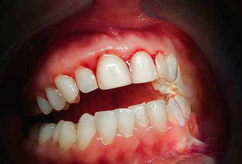 Gingivitis is the initial stage of periodontal disease. If gingivitis goes untreated, it may develop into periodontal disease.