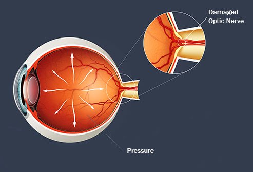 Glaucoma refers to several diseases that damage the optic nerve.
