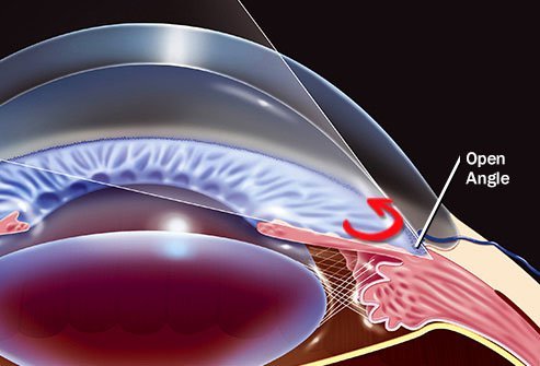 The most common form of this condition is open-angle glaucoma.