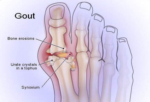 Gout is one of the most frequently referenced medical disorders in the history of mankind.
