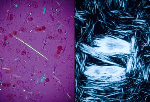 Uric acid crystals from a patient with gout.