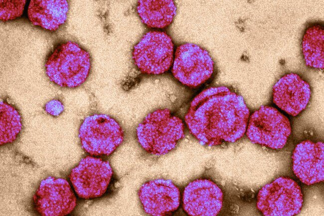 Leukemia is a blood cancer in which the body makes abnormal blood cells.