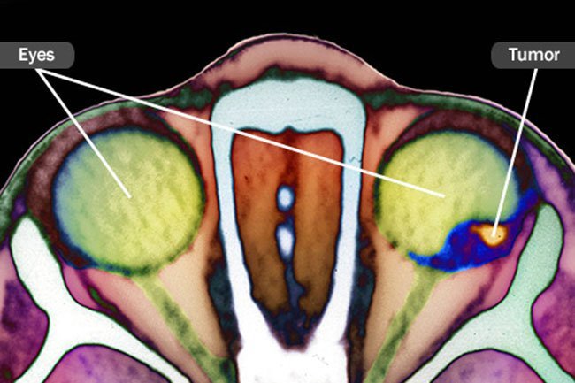 Intraocular cancer is the official name for eye cancer. 